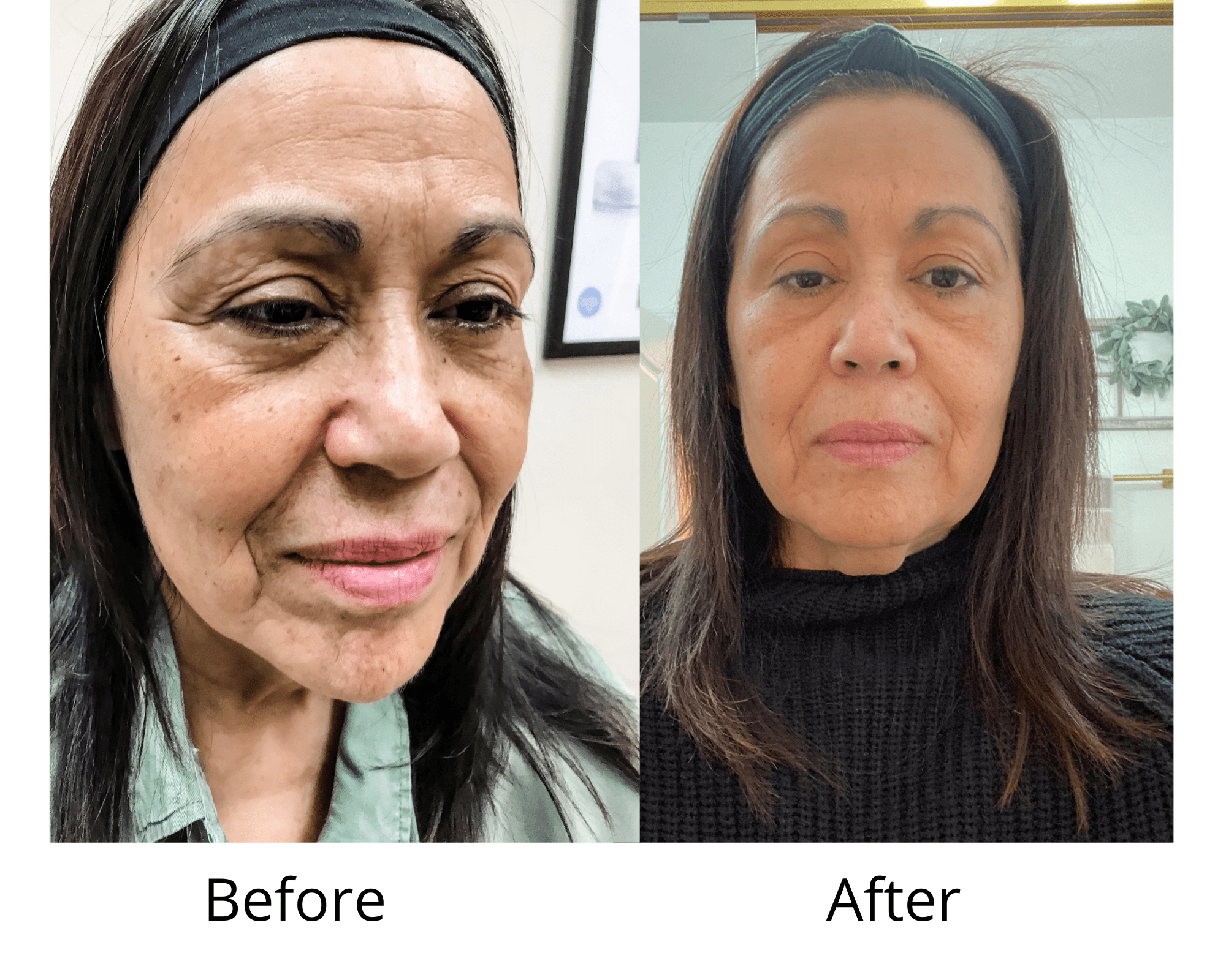 The Benefits Of Facial Aesthetics In Your 60's by top US beauty blog, House of Leo Blog: the benefits of facial aesthetics, image of before and after of fillers for woman in her 60's